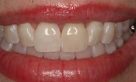 Smile of the Month June 2025 before treatment