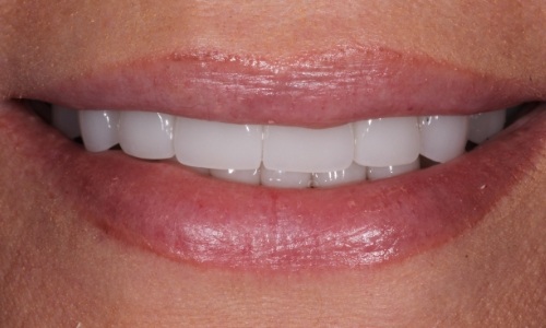 Close-up of brighter, longer teeth after smile makeover