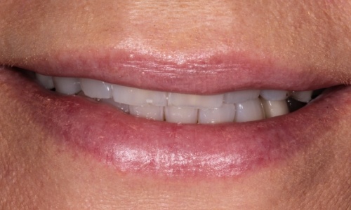 Close-up of dull, worn down teeth before smile makeover