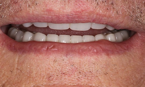 Headshot of Anon  after veneers on Long Island from Dr. Allan Mohr