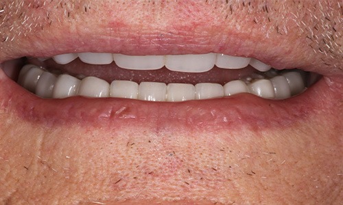 Anonymous patient after space in smile has been filled