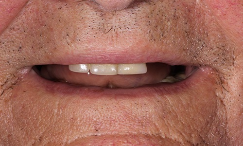 Anonymous patient with empty space in smile