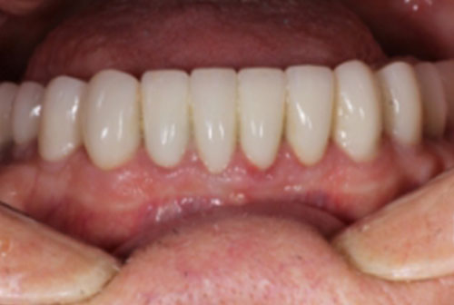 Closeup of Anon  after Long Island veneers