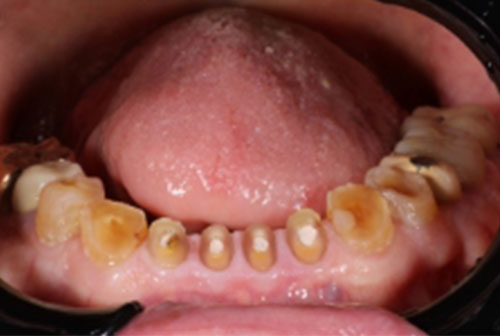Badly decayed teeth in the lower arch