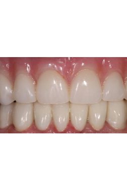 may 2023 Dental implant smile of the month patient