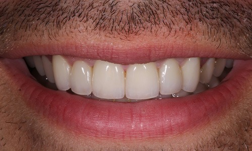 Close-up of teeth that look better-aligned with veneers