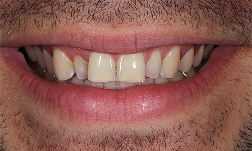 Close-up of overlapping teeth