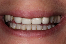 Dental patient Alex's smile before treatment