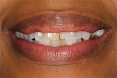 Beryl's smile prior to dental work