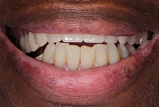 Close-up of smile with damaged teeth