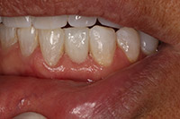 Closeup of tooth replaced with bridge