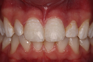 Closeup of repaired front teeth after bonding treatment
