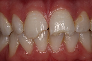Closeup of broken teeth before bonding treatment