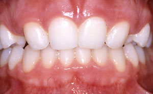 Smile with missing teeth on both sides
