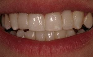 Closeup of smile with front missing teeth replaced with bridges
