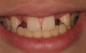 Damaged smile before bridge placement