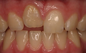 Closeup of short front tooth before bonding