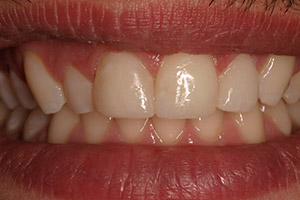 Closeup of of front teeth after bonding treatment
