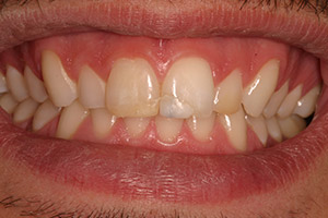 Closeup of discolored teeth before bonding treatment