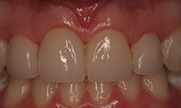 Front teeth with closed gap after bonding treatment