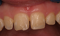 Gapped front teeth before bonding treatment