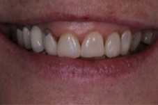 Close-up of gummy smile