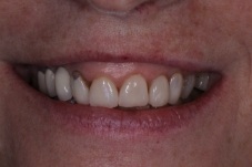 Smile of the Month February 2024 before treatment