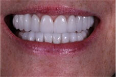 Close-up of smile with more proportional gumline