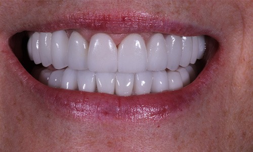Close-up of smile after gumline corrected with smile makeover