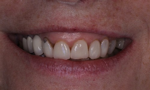 Close-up of dental patient's gummy smile