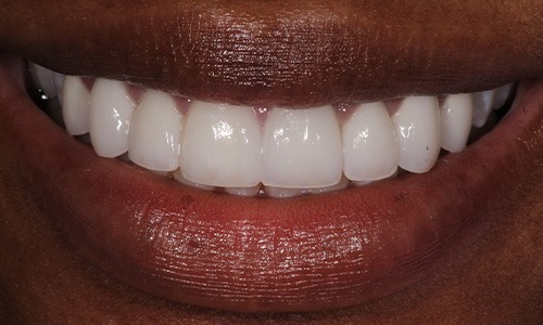 Close-up of teeth with more uniform sizes and color