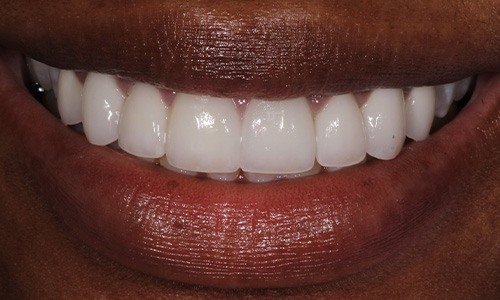 Closeup of Chanique after Long Island veneers