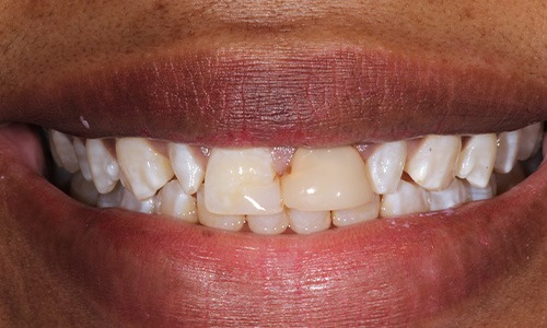 Closeup of Chanique before Long Island veneers