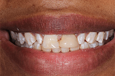 Close-up of Chanique's damaged teeth