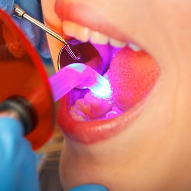 Closeup of patient receiving bonding treatment