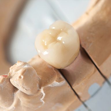 Tooth-colored dental crown on smile model