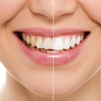 Smile half before and half after teeth whitening