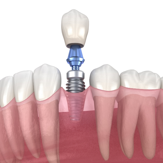 Illustration of a dental implant with a dental crown replacing a missing tooth