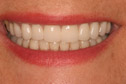 Closeup woman's smile after treatment
