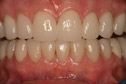 Closeup woman's teeth and gums after treatment