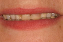 Closeup woman's smile before treatment