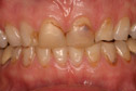 Closeup woman's teeth and gums before treatment