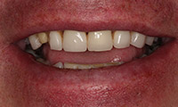 Man smiling clsoeup before dental crowns