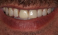 Man's smile aftrer treatment