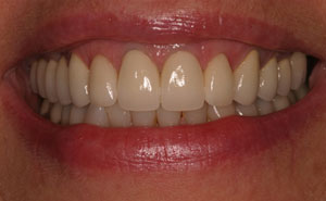 Closeup of healthy teeth and gums after treatment