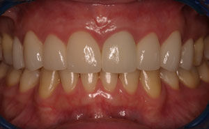Closeup repaired front top teeth
