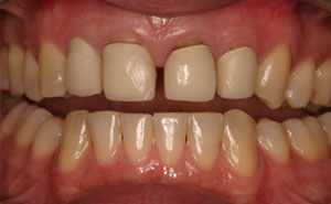 Closeup gapped front top teeth