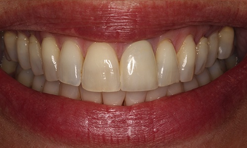 Front tooth replaced with porcelain crown to match natural tooth