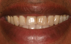 Closeup of uneven teeth