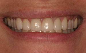 Closeup of flawless white teeth